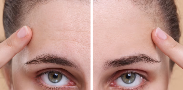 1728912456Forehead-Wrinkle-Treatments